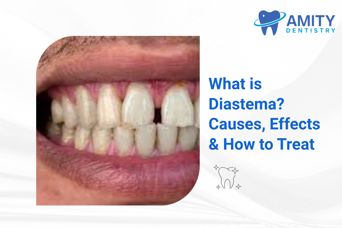 What is Diastema? Causes, Effects & How to Treat a Complete Guide